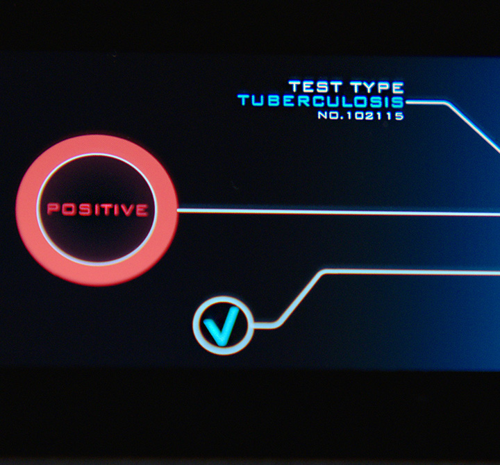 Digital screen showing tuberculosis test results showing positive. 